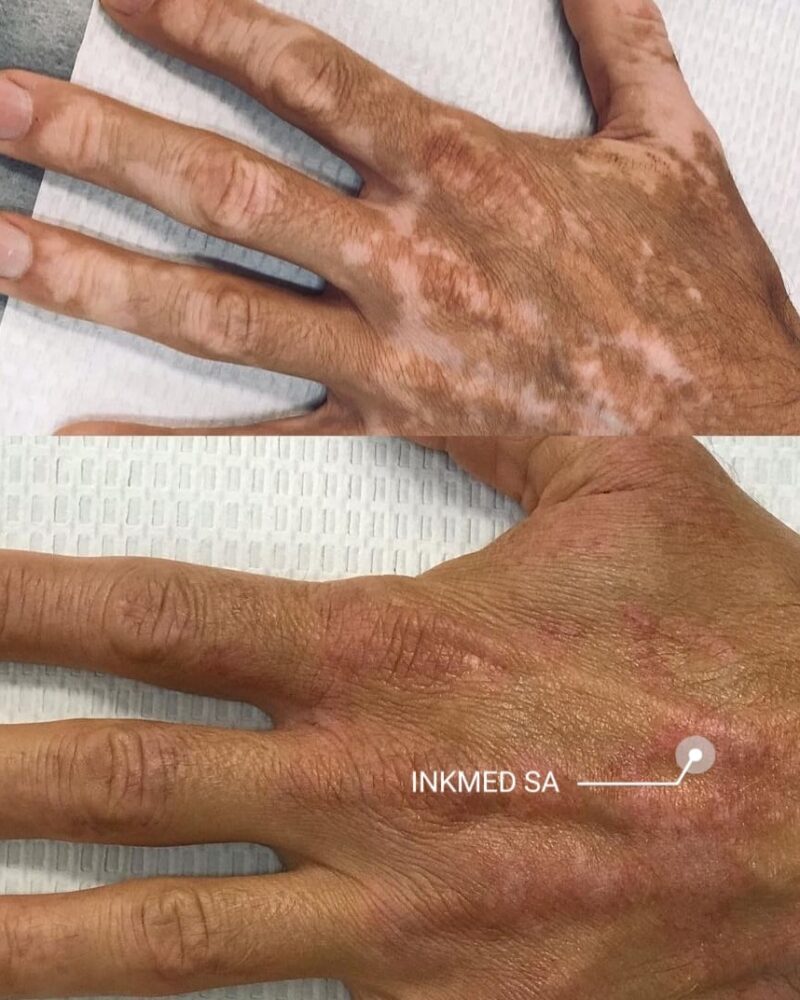 Permanent vitiligo camouflage